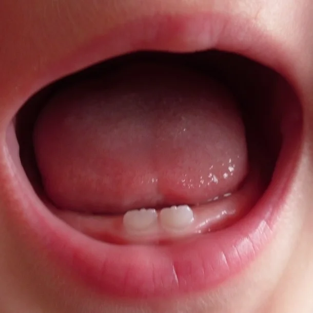 Mamelons, the bumps in new teeth, occur in baby teeth as well as permanent teeth. They often go away on their own, but teens and adults may want to have them re-contoured.