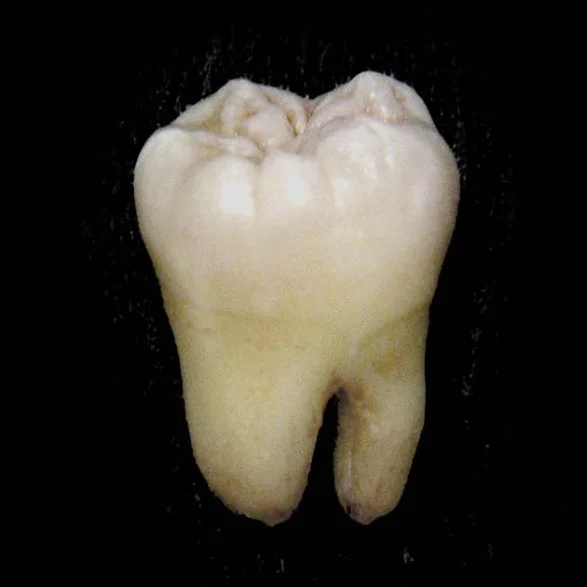 While many dental conditions aren’t specifically genetic, the gene called PAX9 is responsible for the development (or lack of) wisdom teeth.