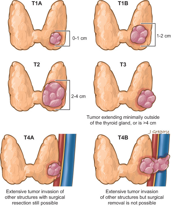 Low Risk Thyroid Cancer Surgery Or No Surgery Gt Health Endocrinology