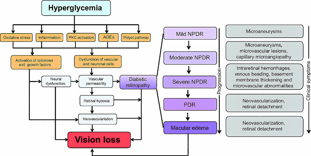 Intravitreal Ranibizumab alkalmazás üvegtestvérzés kezelésében