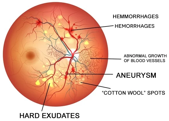 diabetic-retinopathy.jpg
