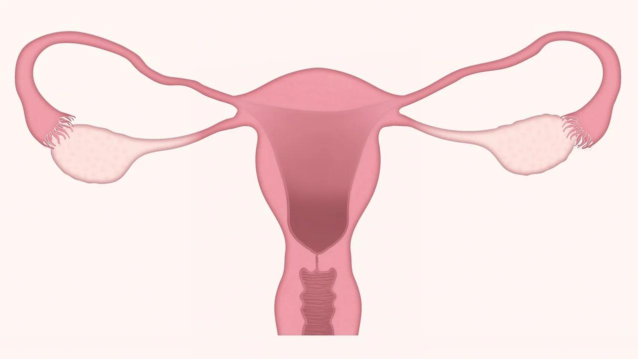 PCOS, Polycystic Ovary Syndrome