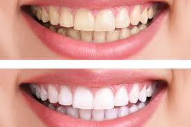 whitening.jpeg