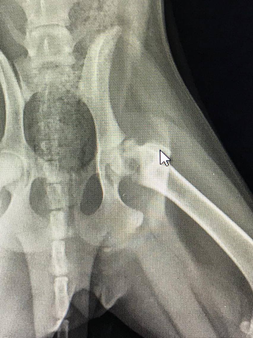The femur ball joint had broken off from the femur and remained in the hip socket