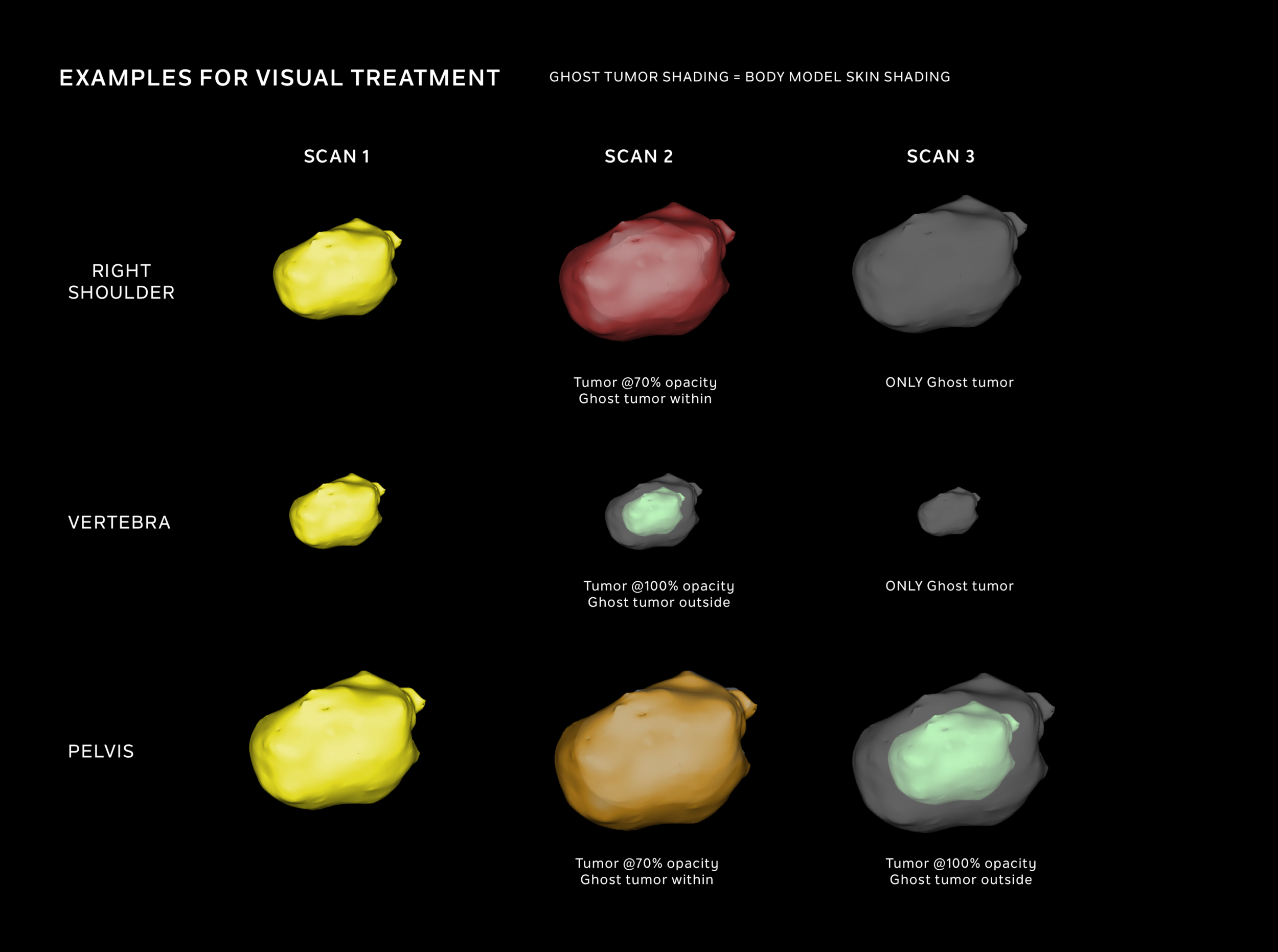 EXAMPLES OF TUMOR TREATMENT.png