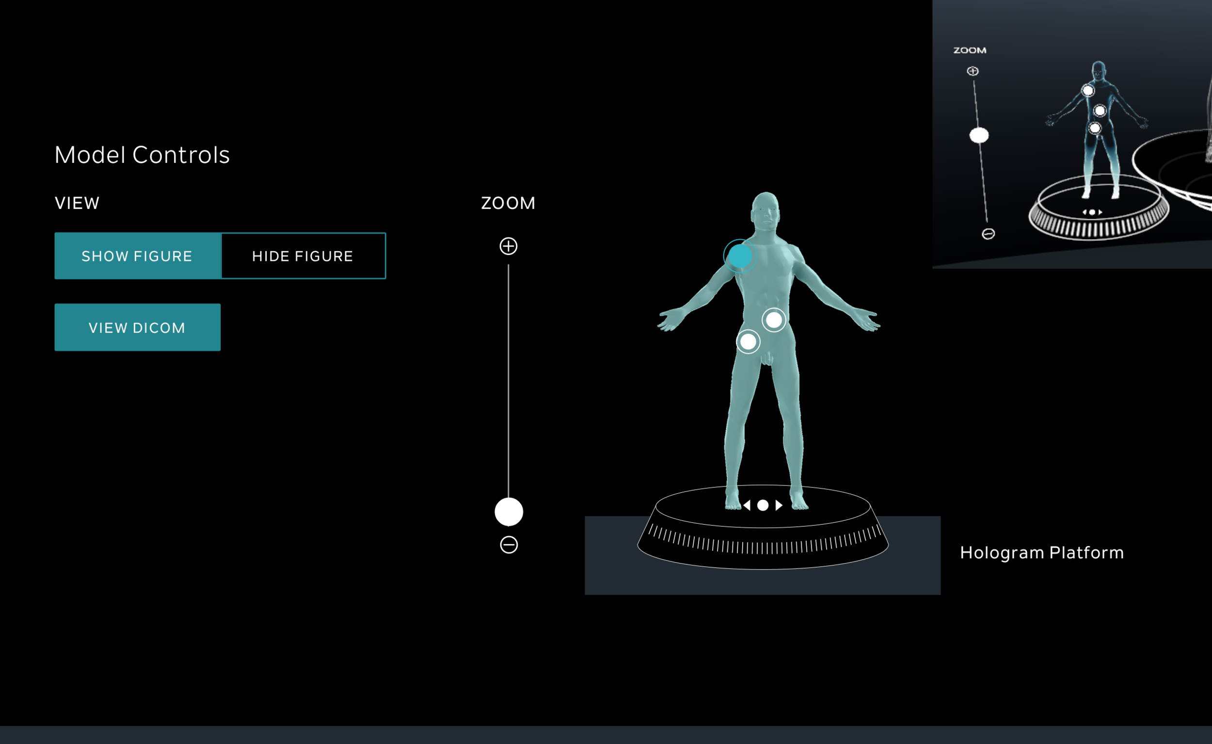 Lesion Hotspots - Now mocked for spheres.png