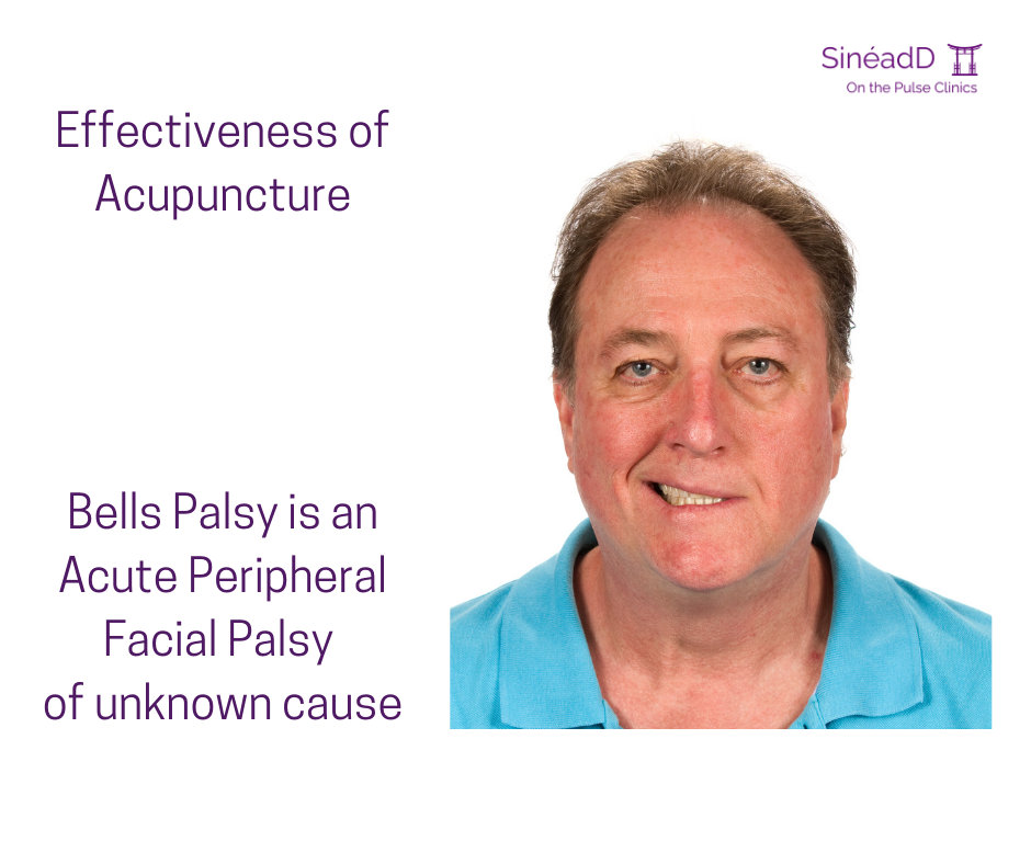 Bell’s Palsy and Acupuncture: What You Need to Know
