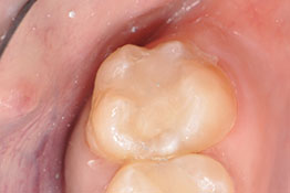 After: Tooth Colored Filling Placed