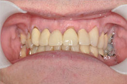 After: Dental Implant & Crown Placed