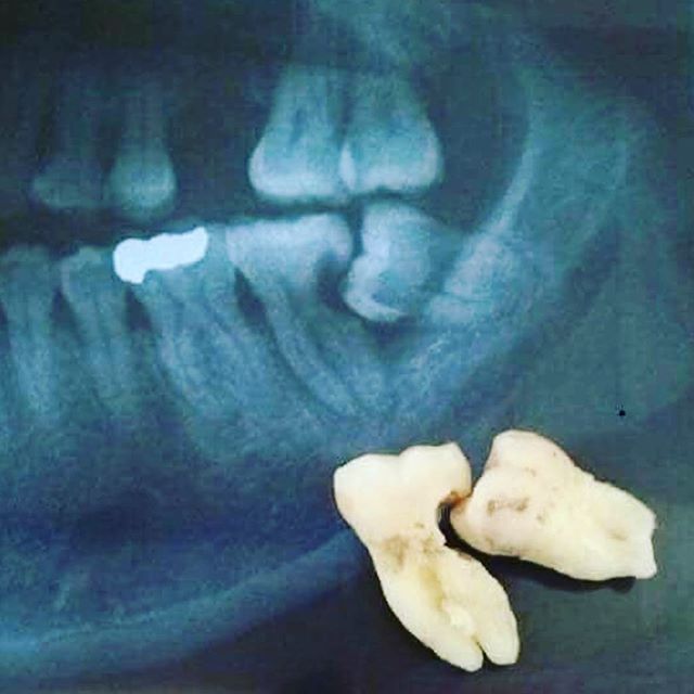 Don&rsquo;t wait until your wisdom teeth hurt to address them! Too often we see people lose two teeth as the result of waiting too long to address them. #rossviewdental #loveyoursmile