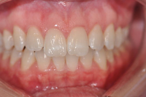 Before: Patient Wanted Whiter Teeth