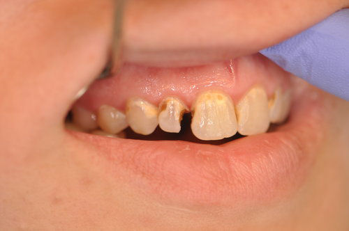 Before: Painful Decayed and Cracked Tooth