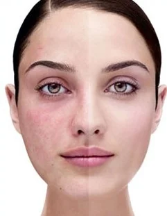 Microneedling
