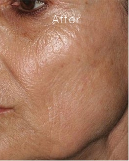 Microneedling 2.jpg