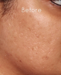 Microneedling 3.jpg