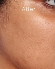 Microneedling 3.jpg