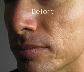 Microneedling 4.jpg