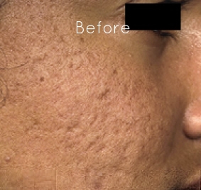 microneedling-before-and-after-acne-scars.jpg