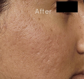 microneedling-before-and-after-acne-scars.jpg