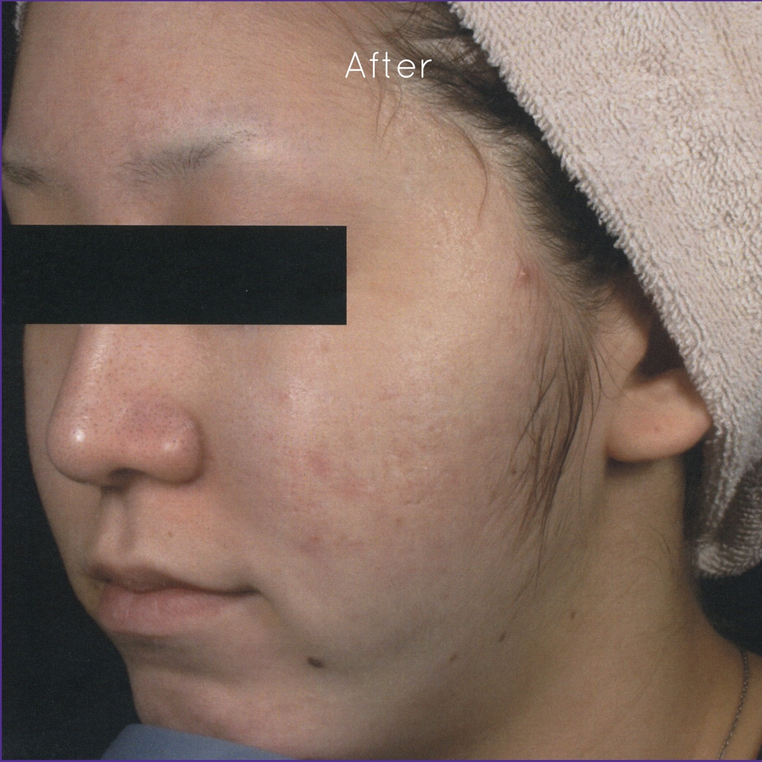 Dr.-Masaki-Sato-Japan-Acne-Scars-after.jpg