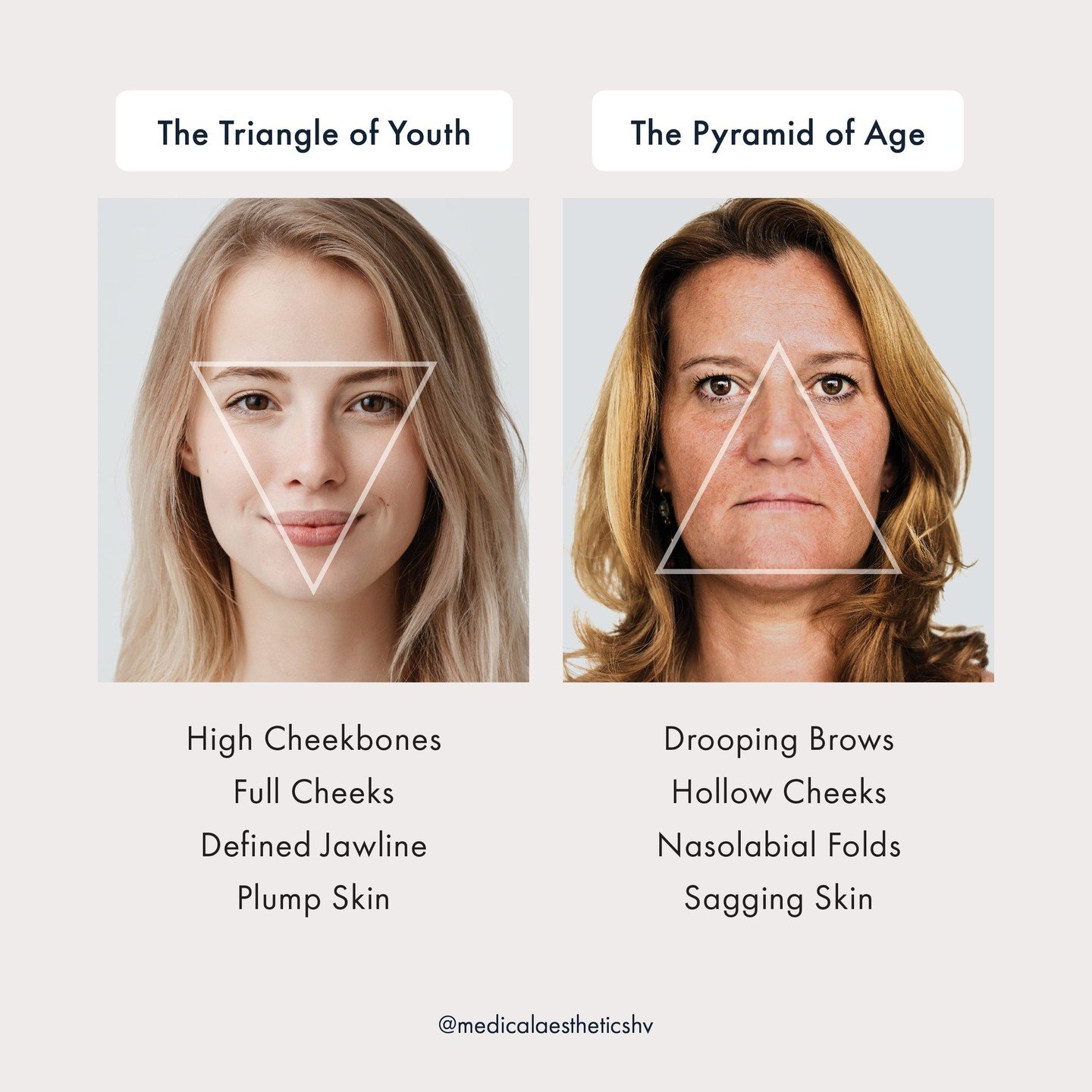 RESTORE YOUR GLOW WITH BIOSTIMULATORS, FILLERS AND THREADS 🤩 Facial contouring can help rebuild volume in the mid-face and restore the triangle of youth. The triangle of youth becomes inverted with age due to tissue laxity. As we lose some of our fa