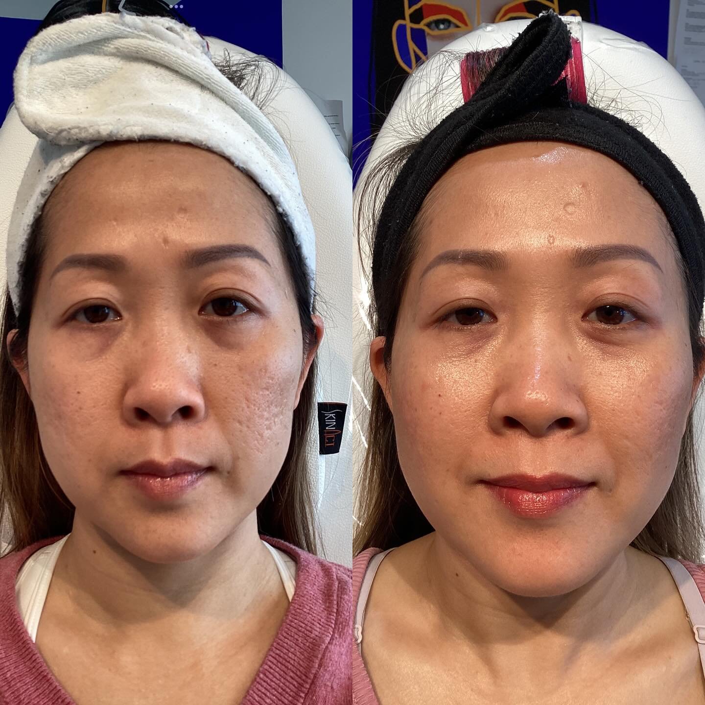Results after 4 sessions of Radio Frequency Microneedling and 1540 

Improve:
Skin Tone 
Skin Texture 
Fine lines &amp; Wrinkles 
Acne Scarring 
Surgical Scarring 
Sun Damage 
Stretch Marks 

The combination of therapies encourages skin to regrow, re