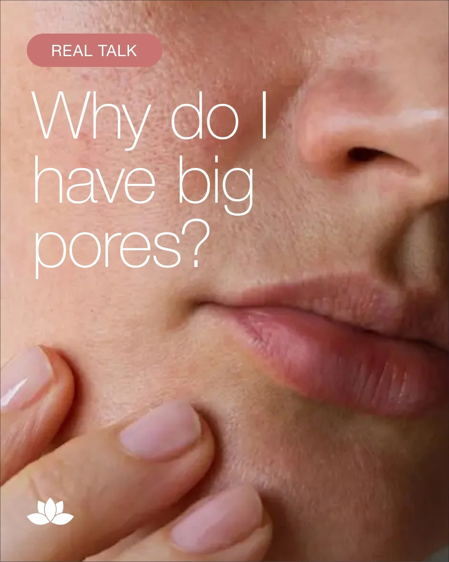 Big pores bothering you? 👀 Even though pores don&rsquo;t actually change, loss of collagen and skin elasticity make them look bigger. 💡 Treatments that tighten your skin and boost collagen, like CO2 Laser, deliver BIG results to minimize their appe