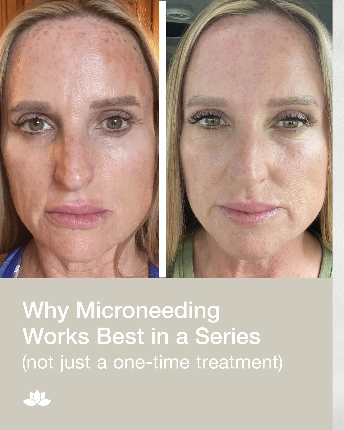 Microneedling is not a &ldquo;one and done&rdquo; treatment, and it&rsquo;s not supposed to be. ✌🏽 It works by triggering your skin&rsquo;s natural repair process. That means collagen forms gradually, in phases, over time. 

One session starts the s