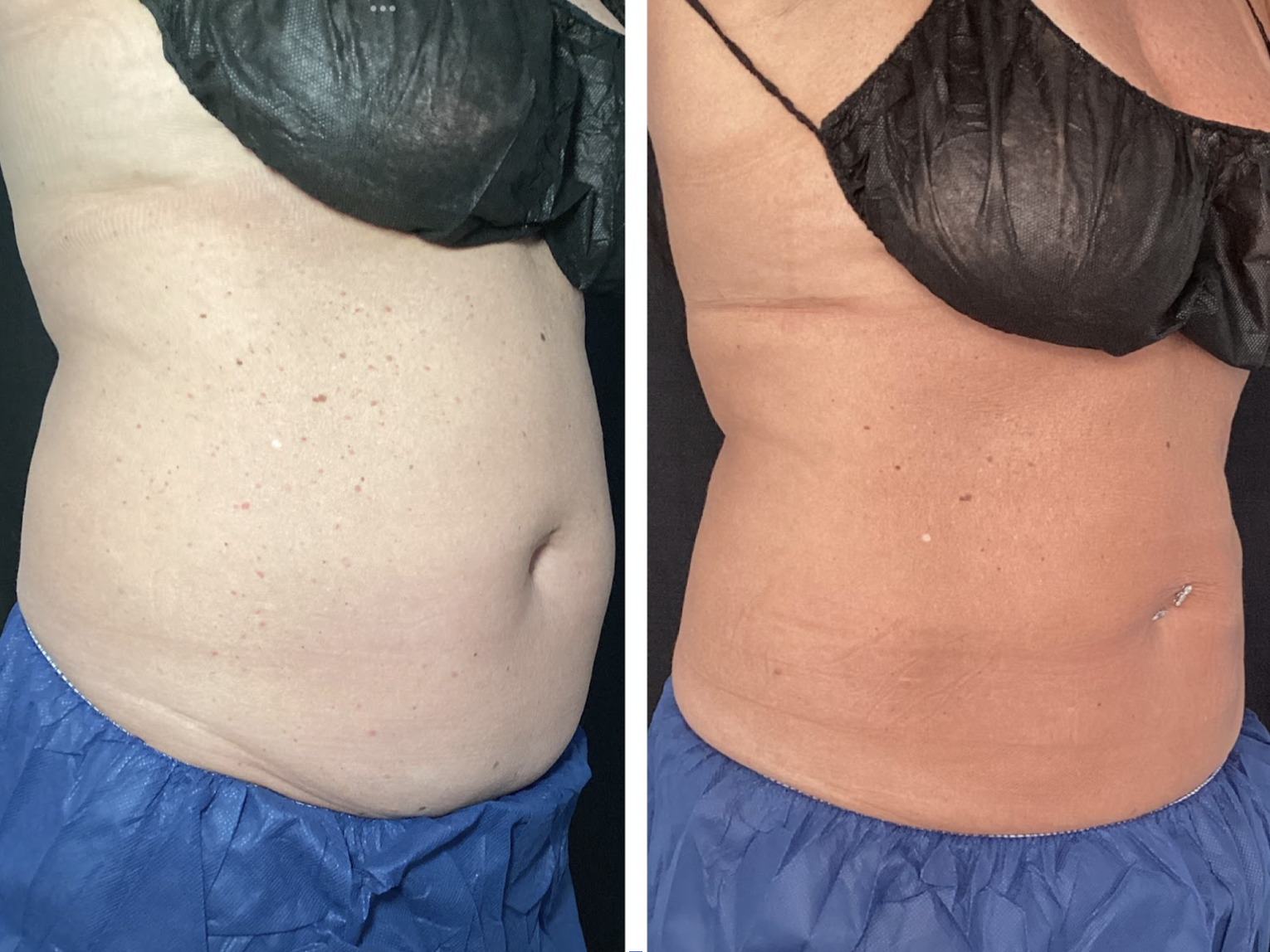 Stubborn Lower Belly Fat?  How One Hudson Valley Gal Finally Saw Results