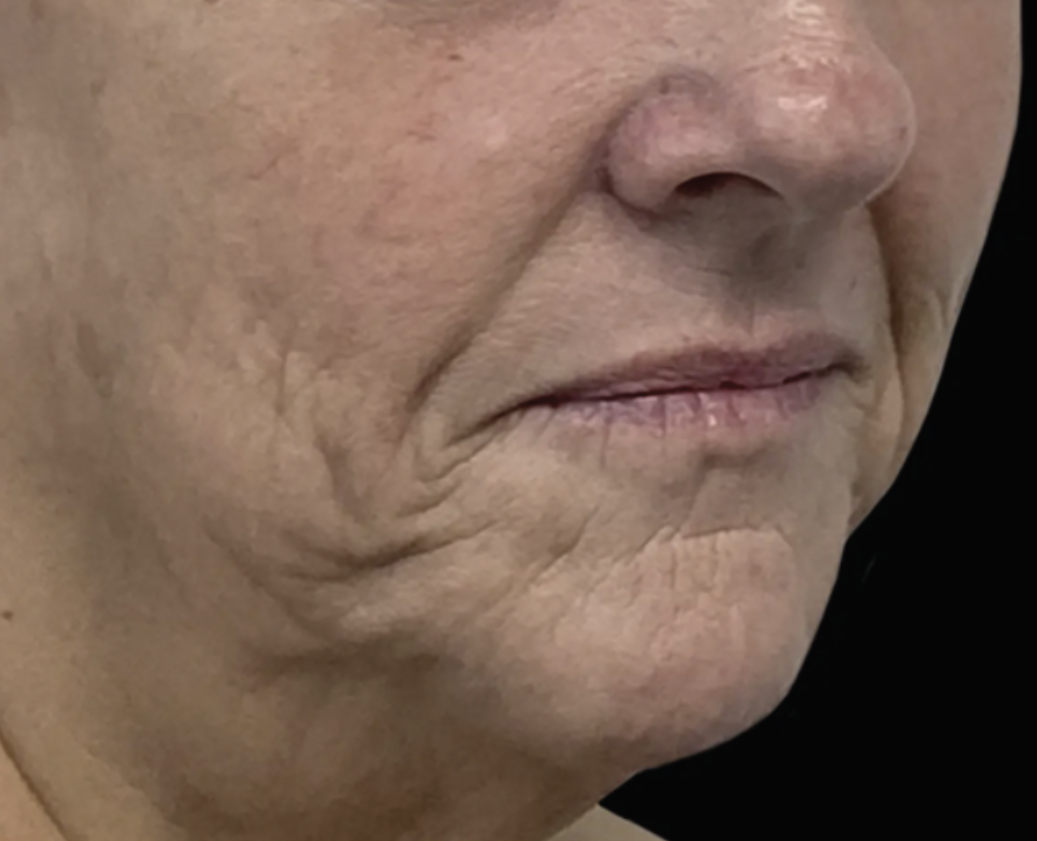 Filler vs. Ellacor: Which Treatment Is Best for Jowls?