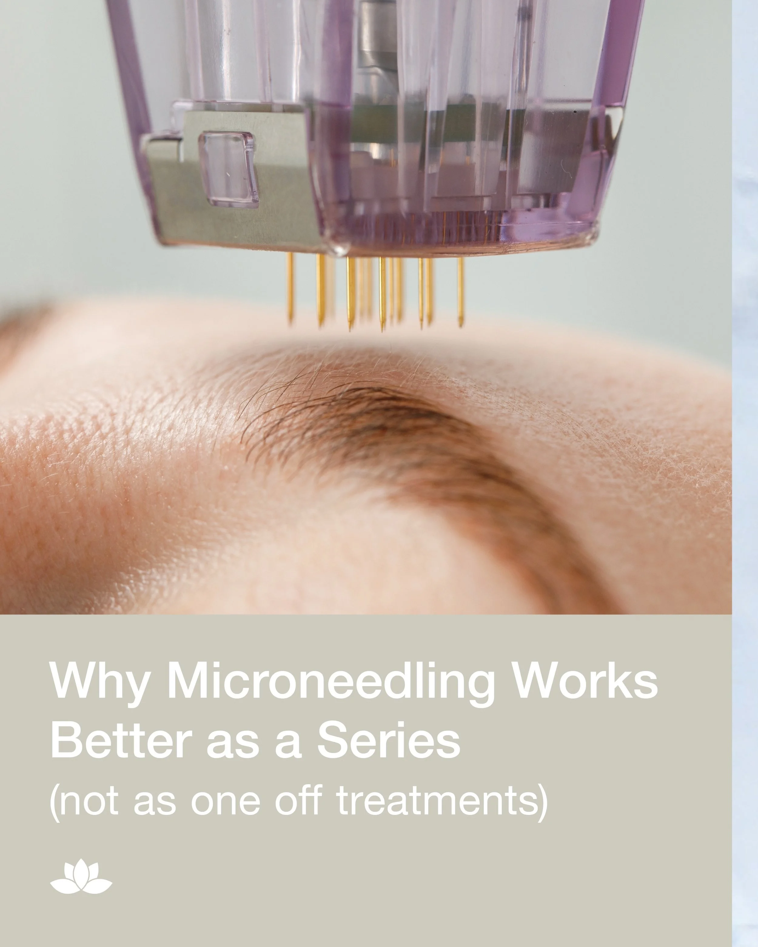 One Microneedling treatment can give your skin a boost, but a series of treatments is where the real transformation happens. 💕

Microneedling works by stimulating your body&rsquo;s natural collagen production, and collagen remodeling takes time. Wit