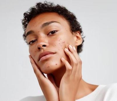 The Problem With Most Acne Treatments? They Aren’t Designed for Your Skin.