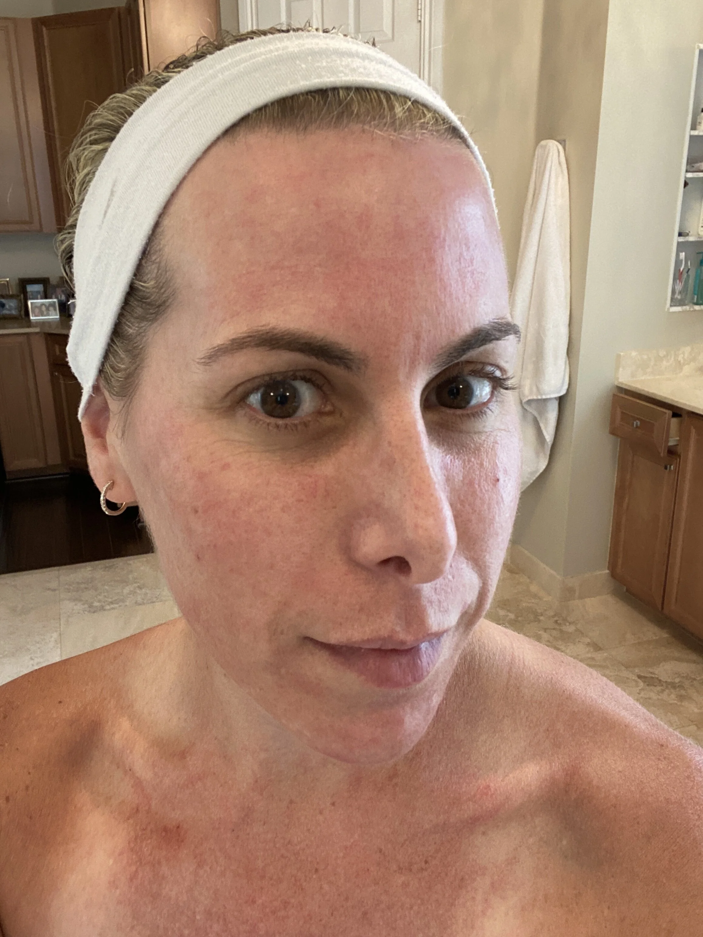 A Method AMAZING Peel update