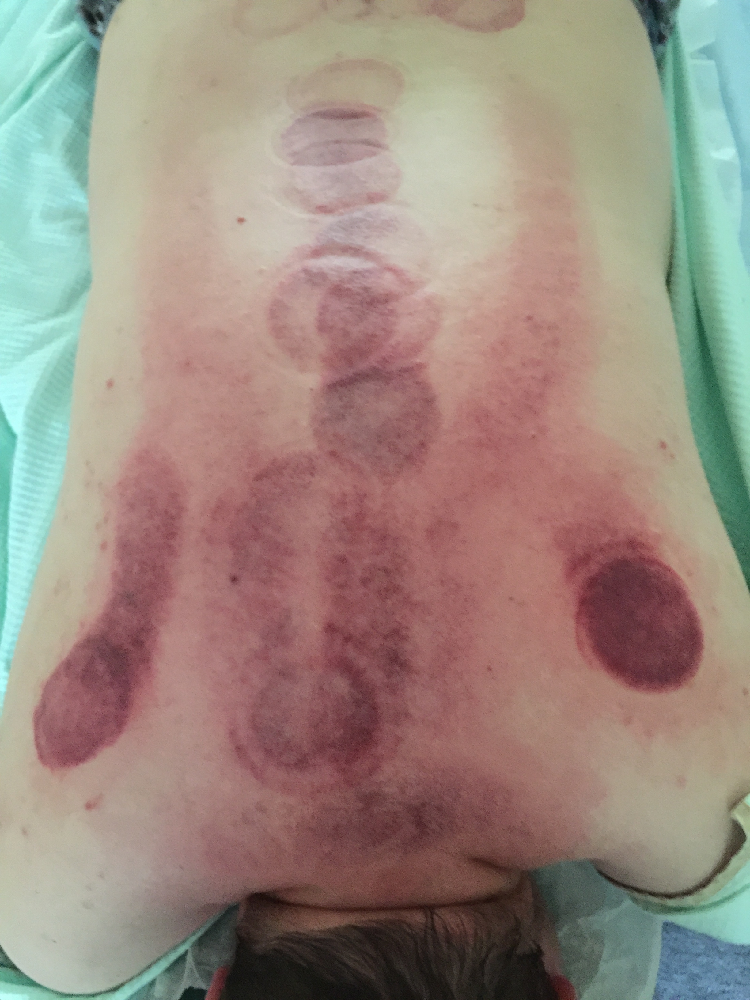 Cupping treatment for back pain performed by Dr. Chin
