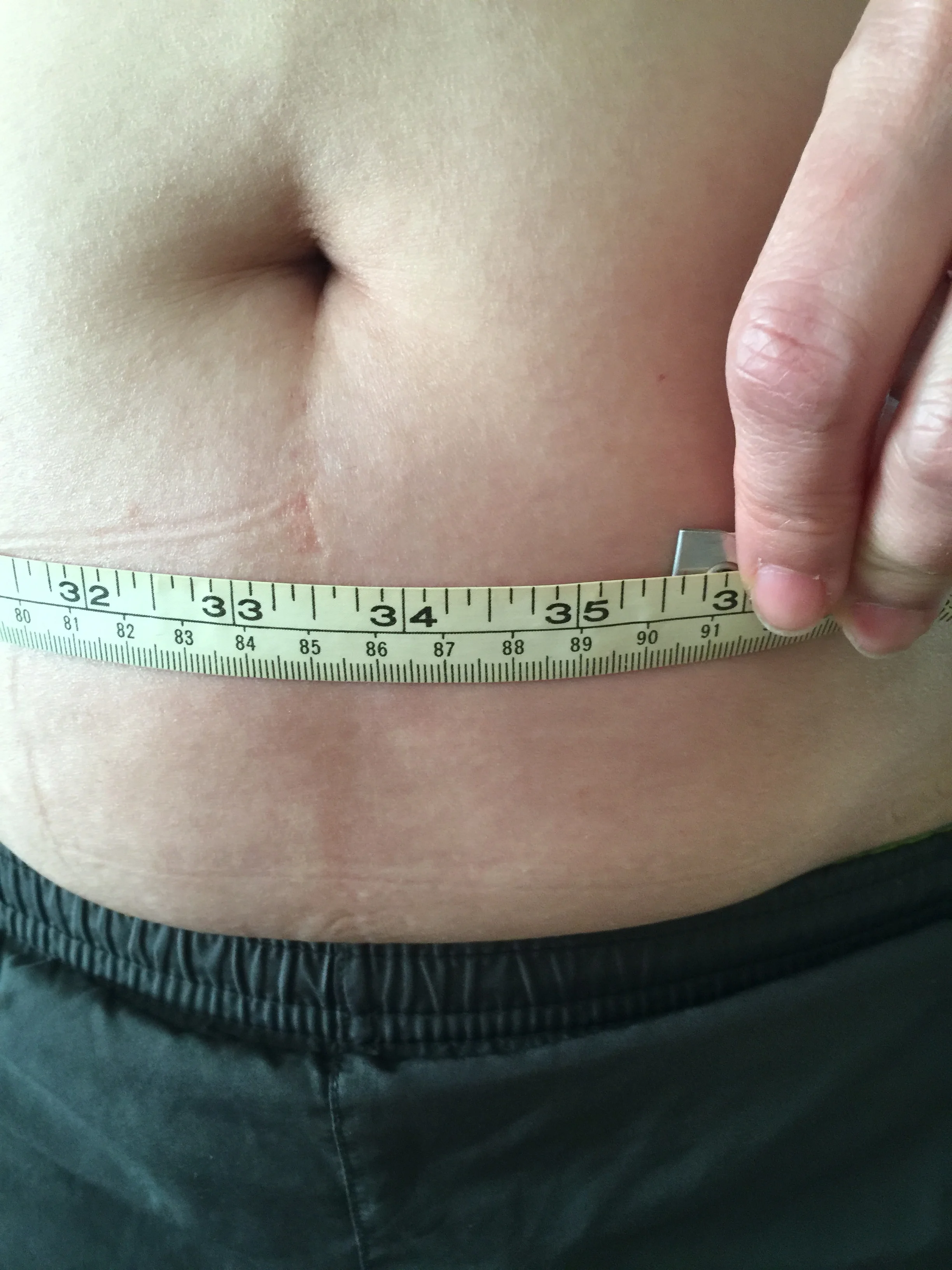 Acupuncture Weight Loss Treatment -- Before treatment