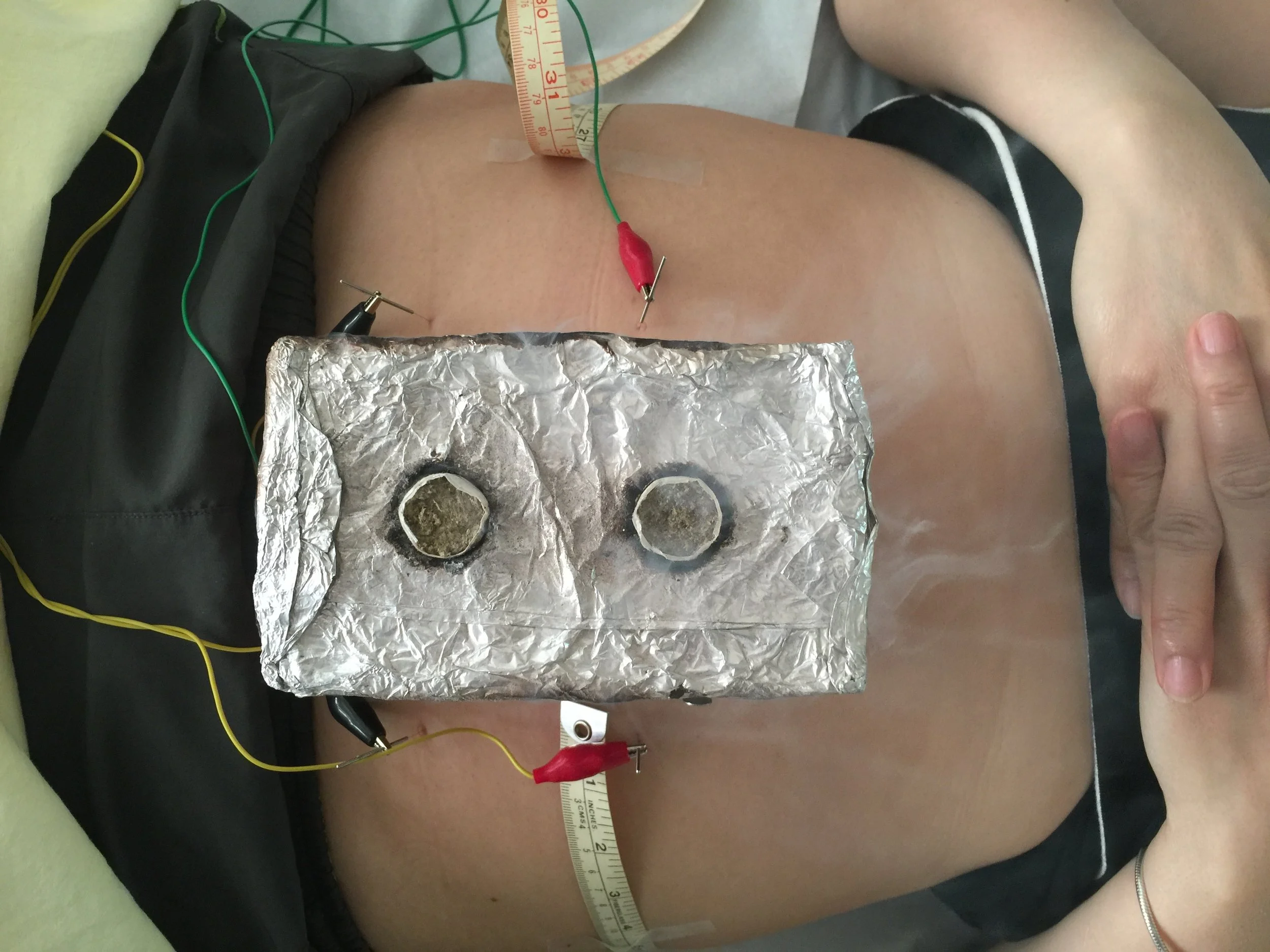 Acupuncture Weight Loss Treatment -- Moxibustion and Electro Acupuncture Needling