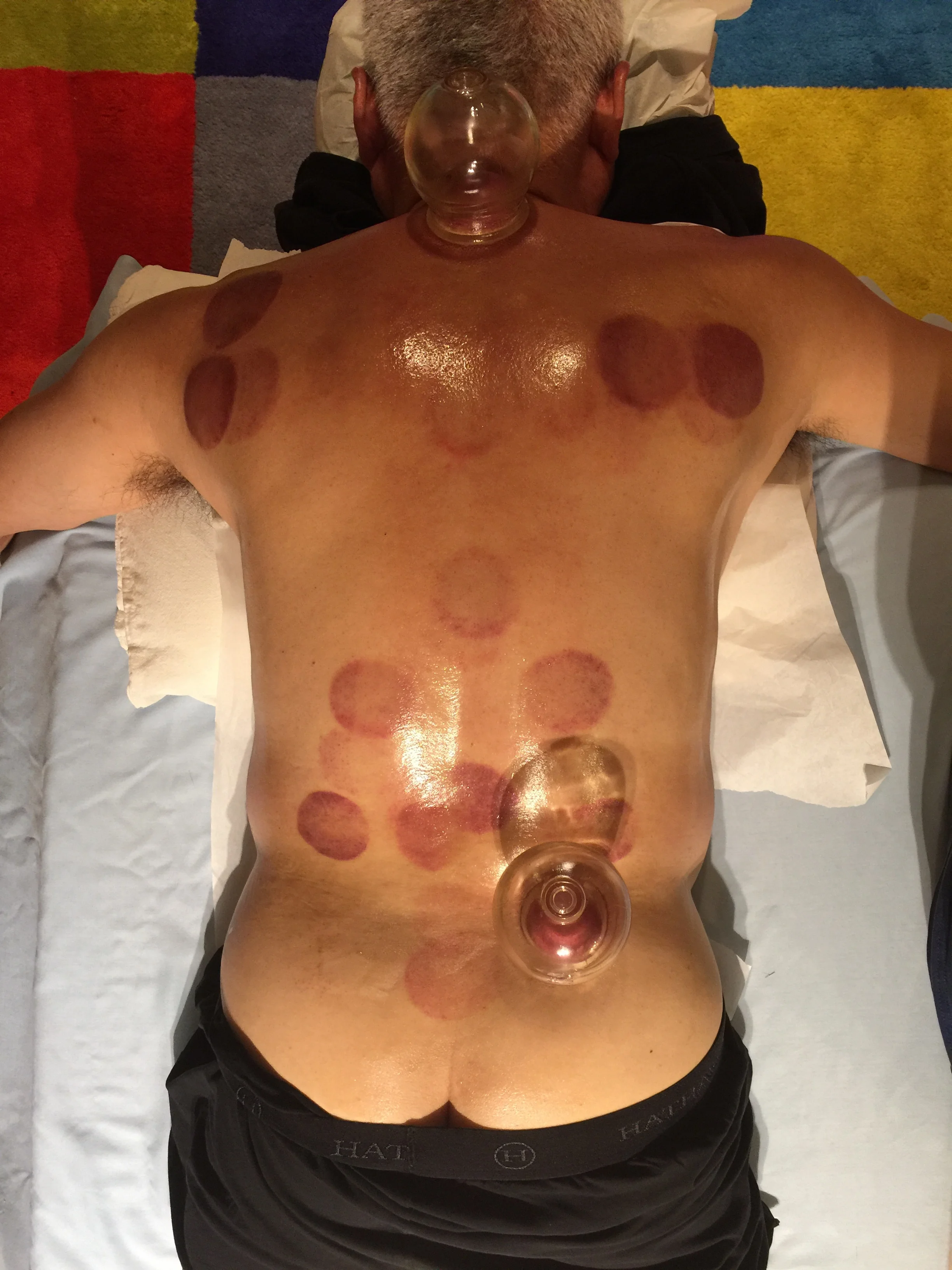 Acupuncture Cupping Demonstration