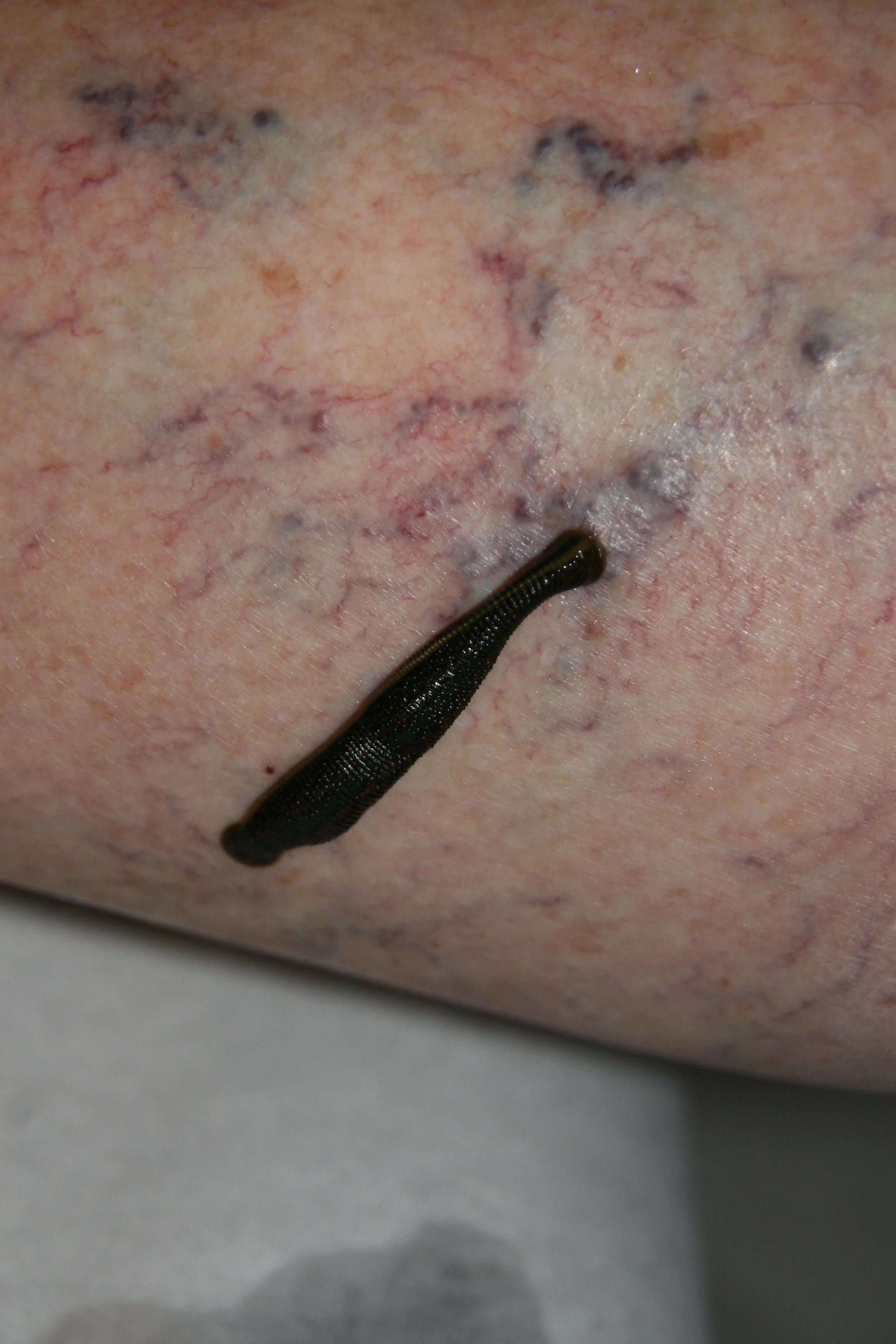 Leech Therapy -- Thrombophlebitis