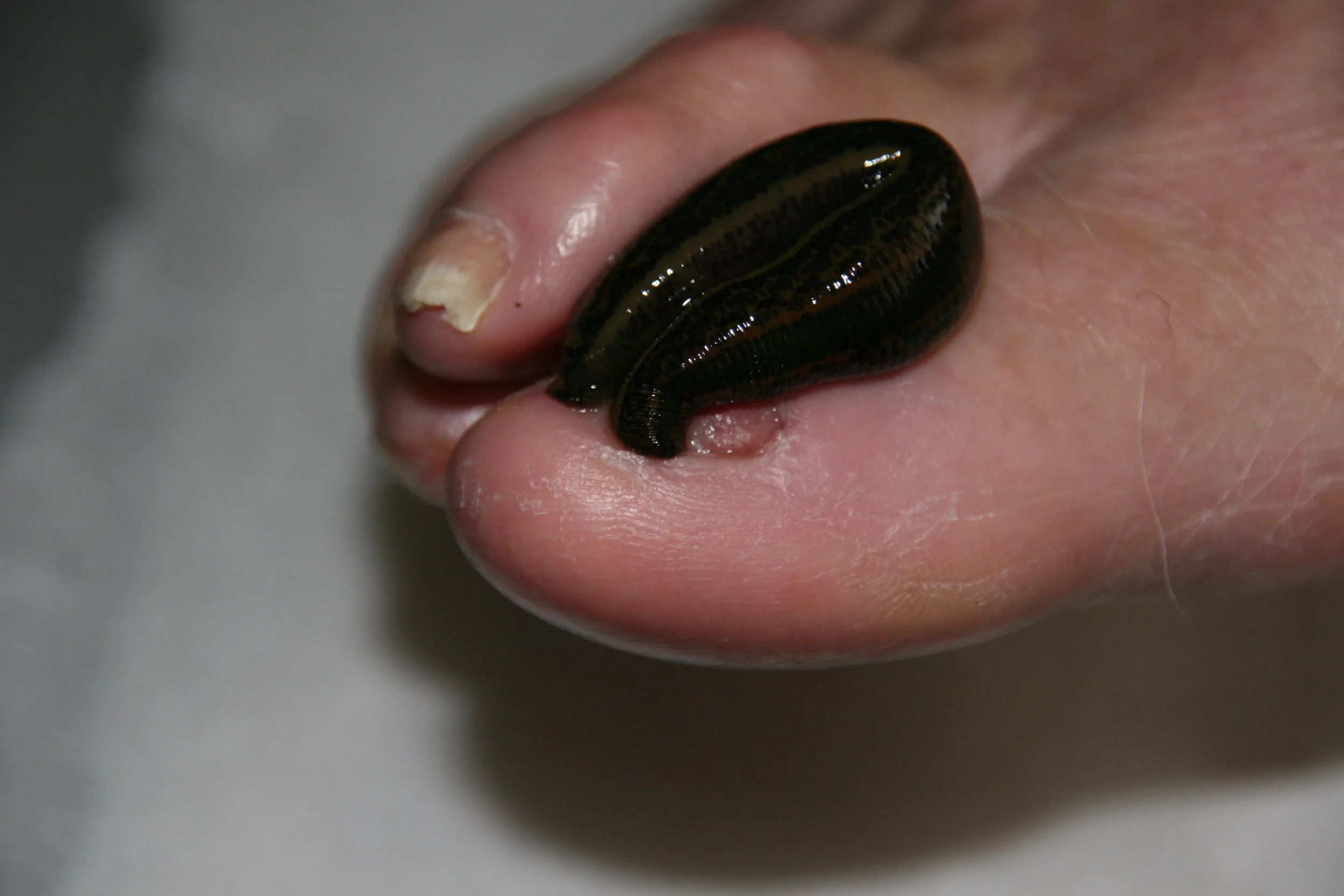 Leech Therapy -- An Infection on the Toe