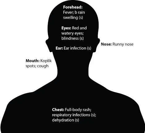 Measles affects several parts of the body. The symptoms marked with (s) are more severe.Graphic by Ronnie Kaufman, Art Director.