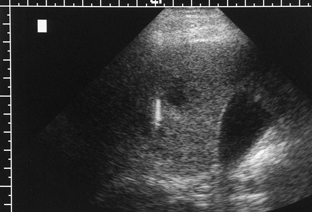 Liver Biopsy with 20ga SampleMASTER™