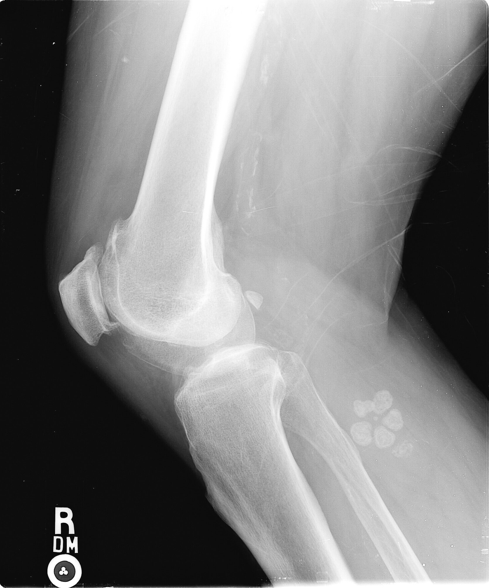  The flower petal-shaped object with the density of bone found in the calf muscle below Terry’s right knee. 