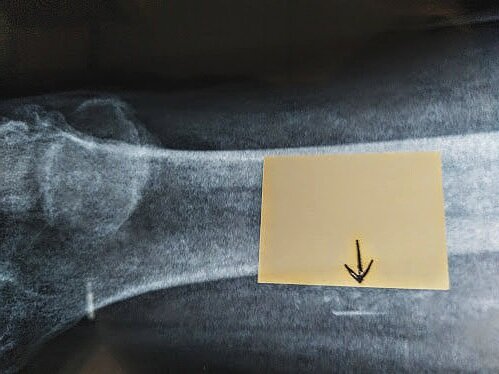  X-ray from Nov 16, 2017, after the anomaly extraction.  The square metal piece is gone, but the thin wire was left. 