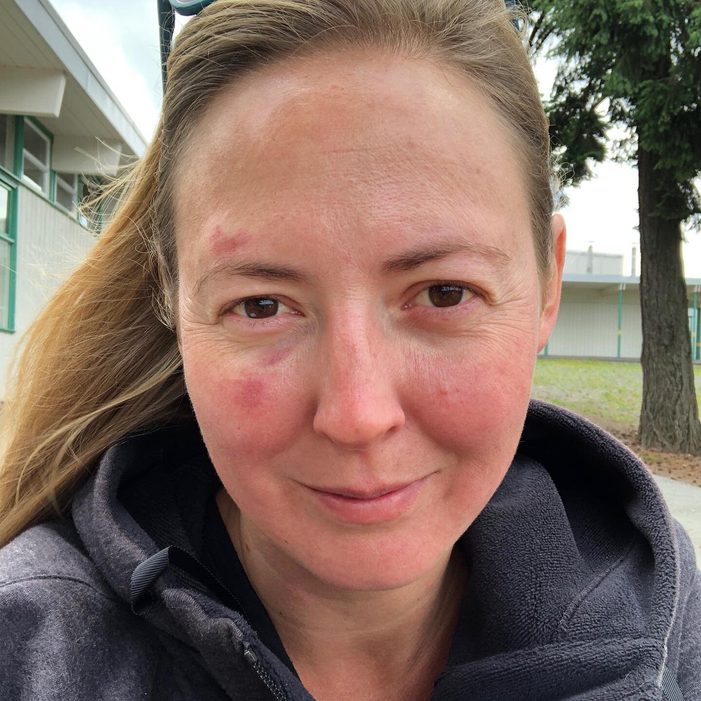 Testimony Tuesday...on a Monday!
This message came today from Kelly in Nanaimo, BC...
&ldquo;Yesterday, I tripped over my feet and the heavy backpack I was wearing drove my face straight into the ground. Luckily I had our first aid kit with some Heal