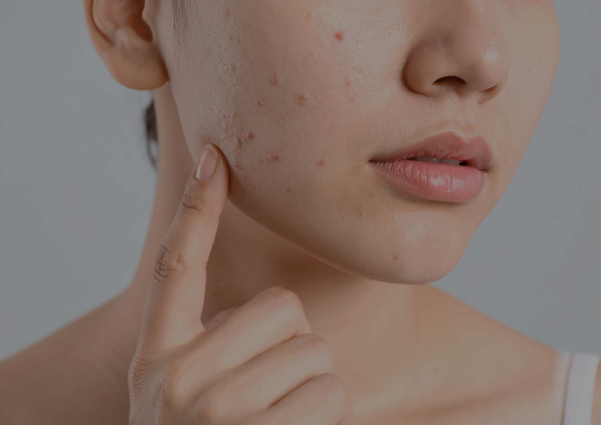 Your Acne Might Be Telling You More Than You Think