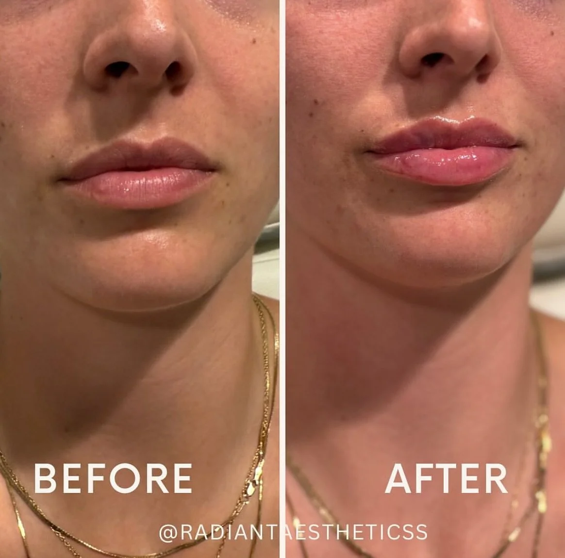 Repost from Makenzie @radiantaestheticss
&bull;
&bull;
Lip transformation😍 This patient got just under a syringe of filler to get these subtle, gorgeous results! We added volume, hydration, and enhanced her natural lip boarder with filler. Results w