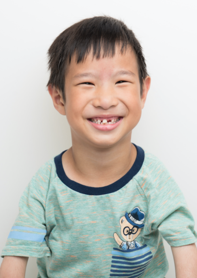 GONG ZQ Medical Condition: Multiple joint deformities