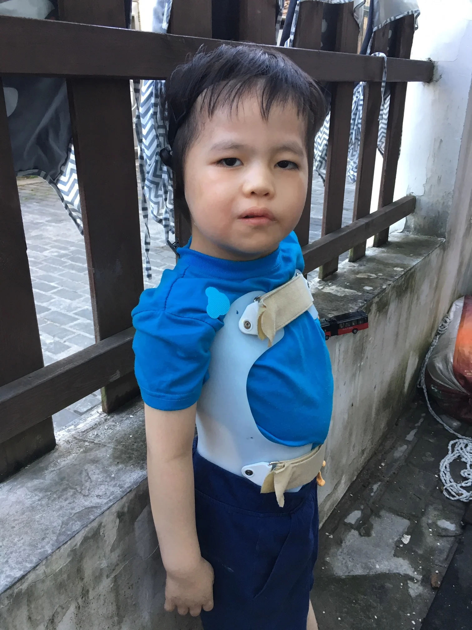 PU FX Medical Condition: Scoliosis, ear malformation and hearing impairment