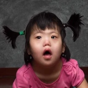 ZHAO JY Medical Condition: Down Syndrome