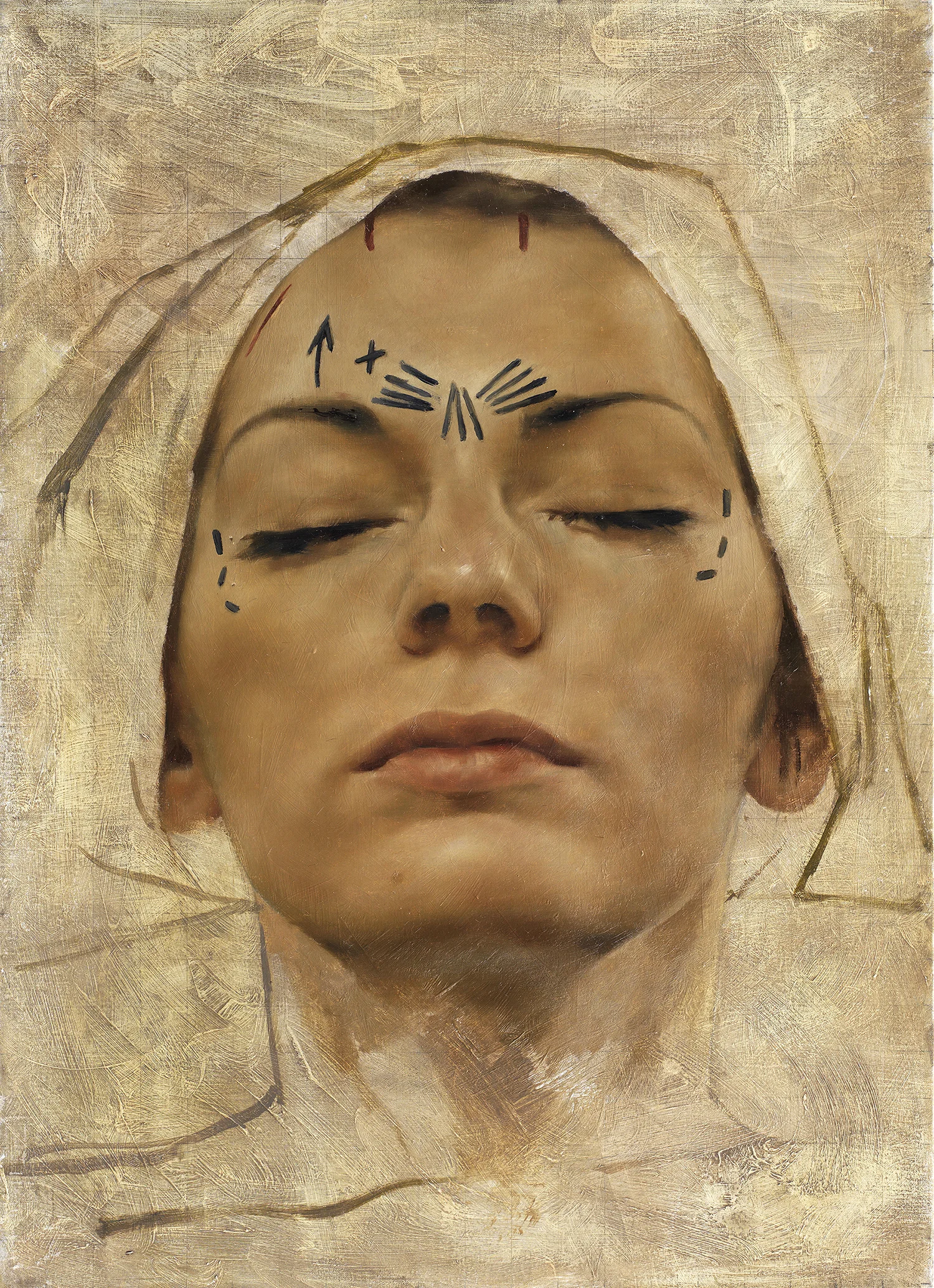 Endobrow Lift II.jpg